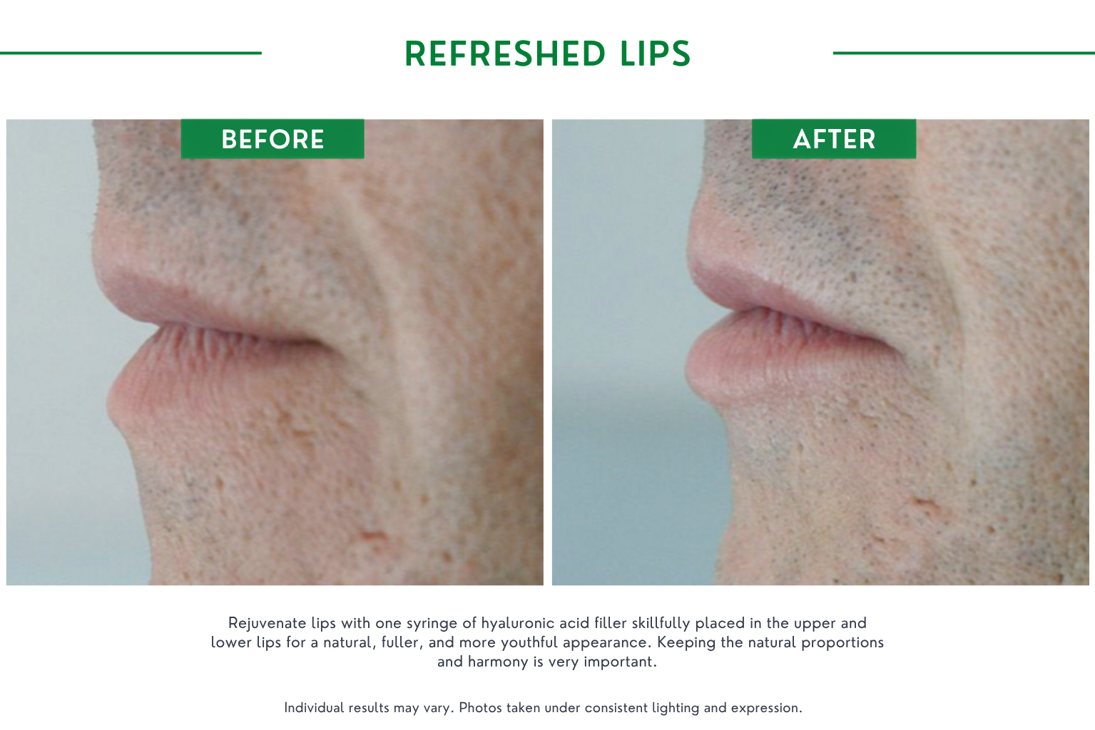 Fillers B_A (12)