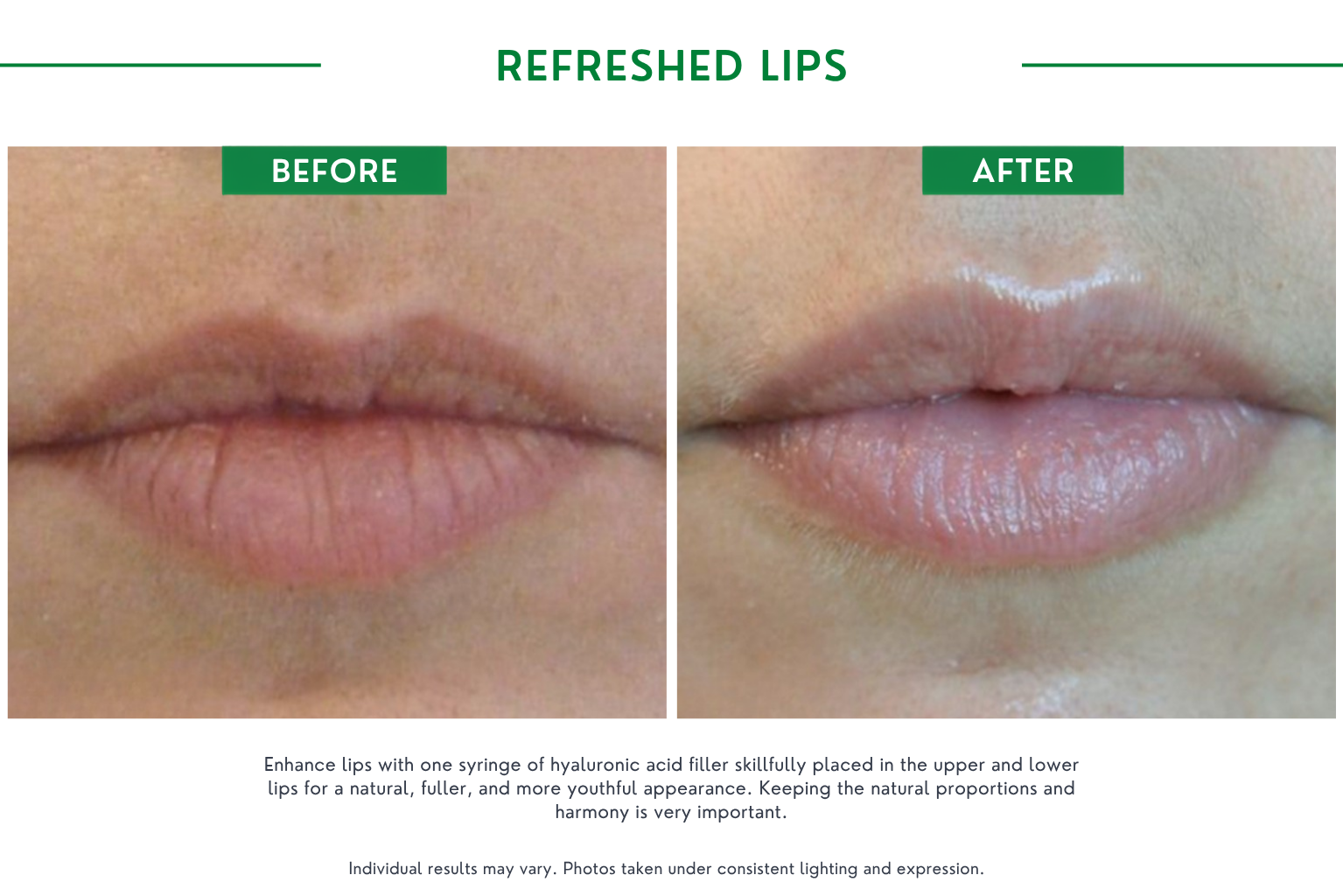 Fillers B_A (13)