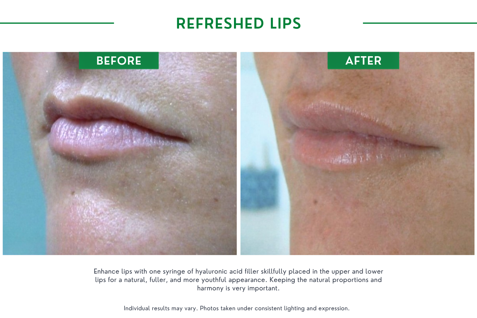 Fillers B_A (15)