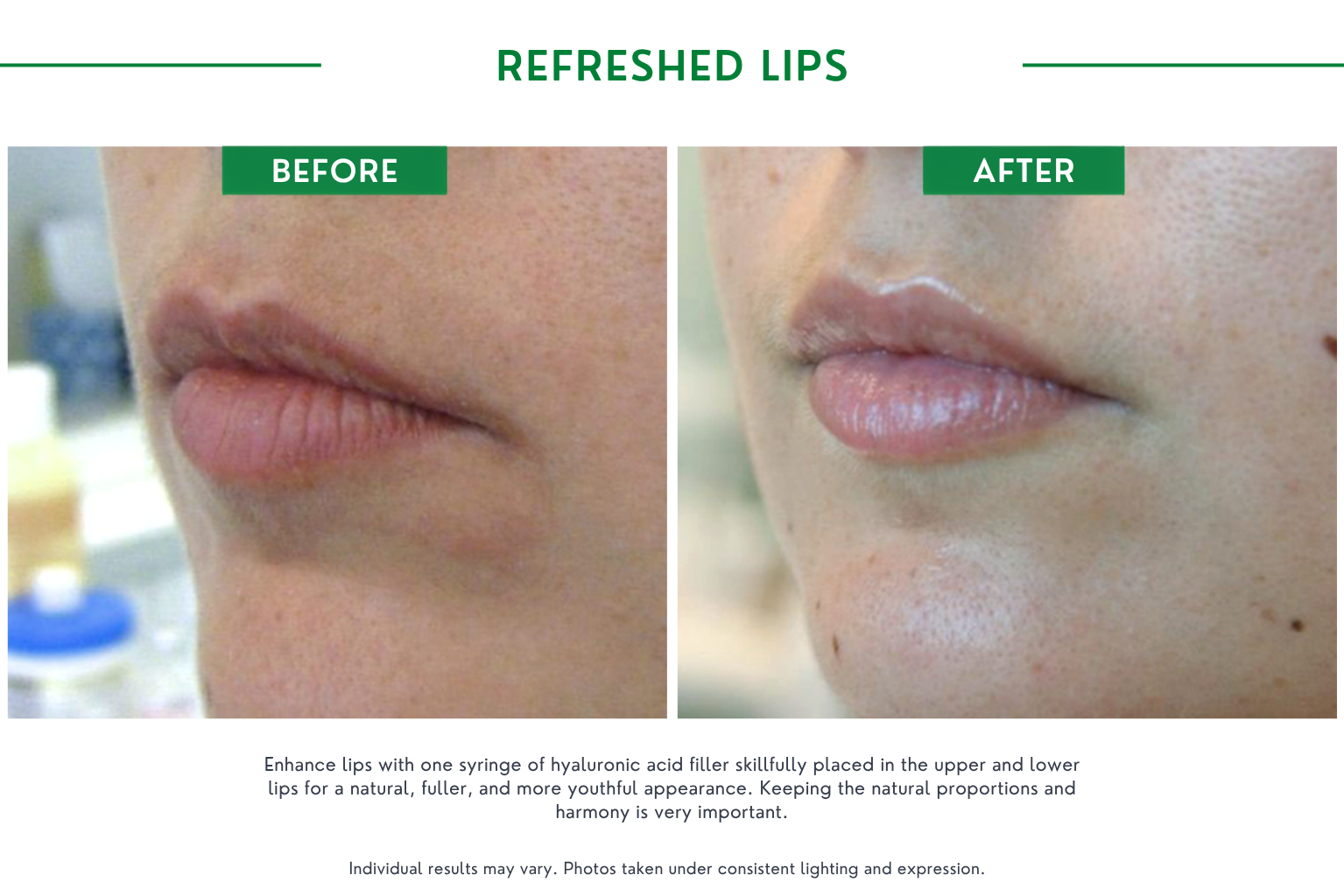 Fillers B_A (16)