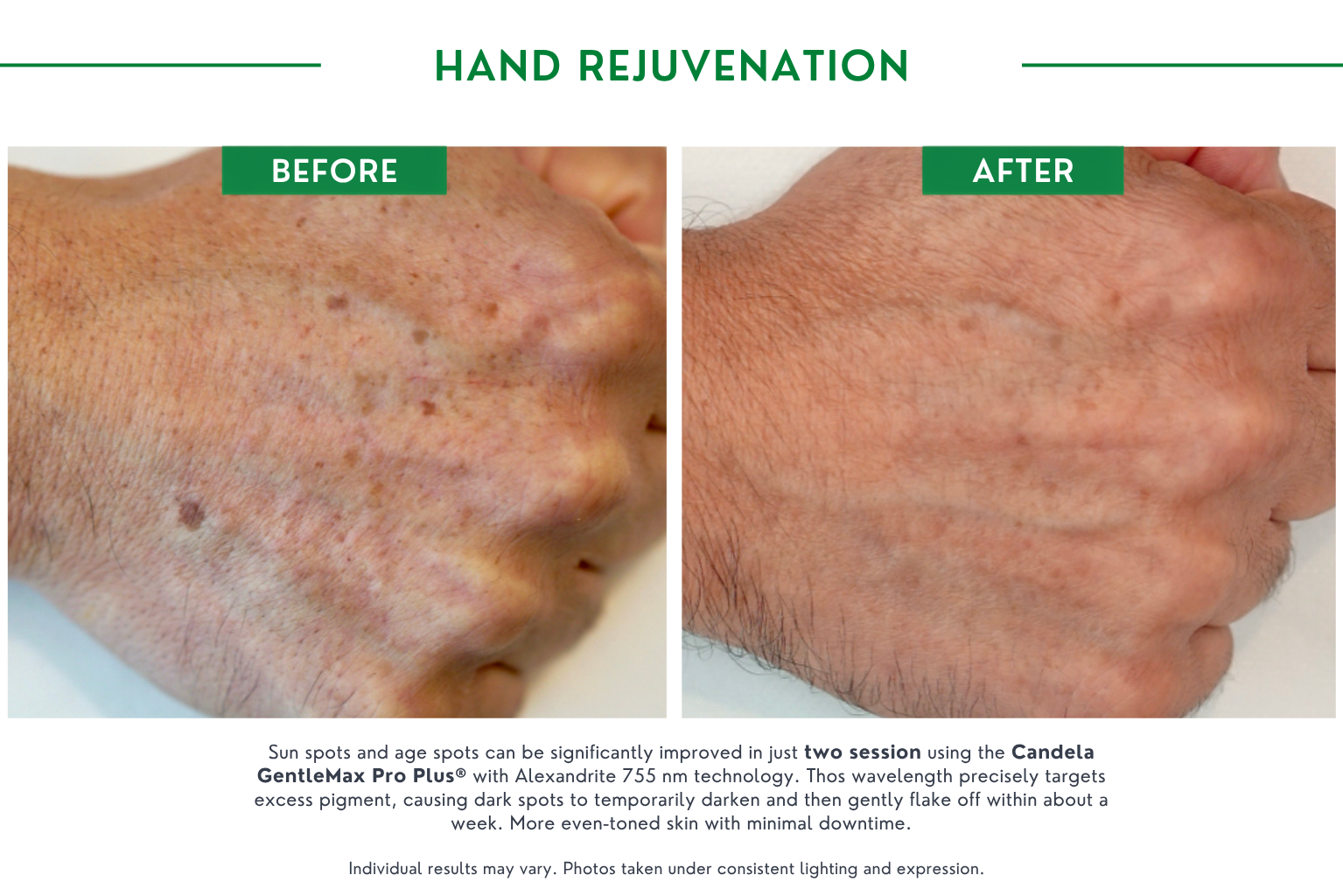 Hand rejuvenation B_A (1)