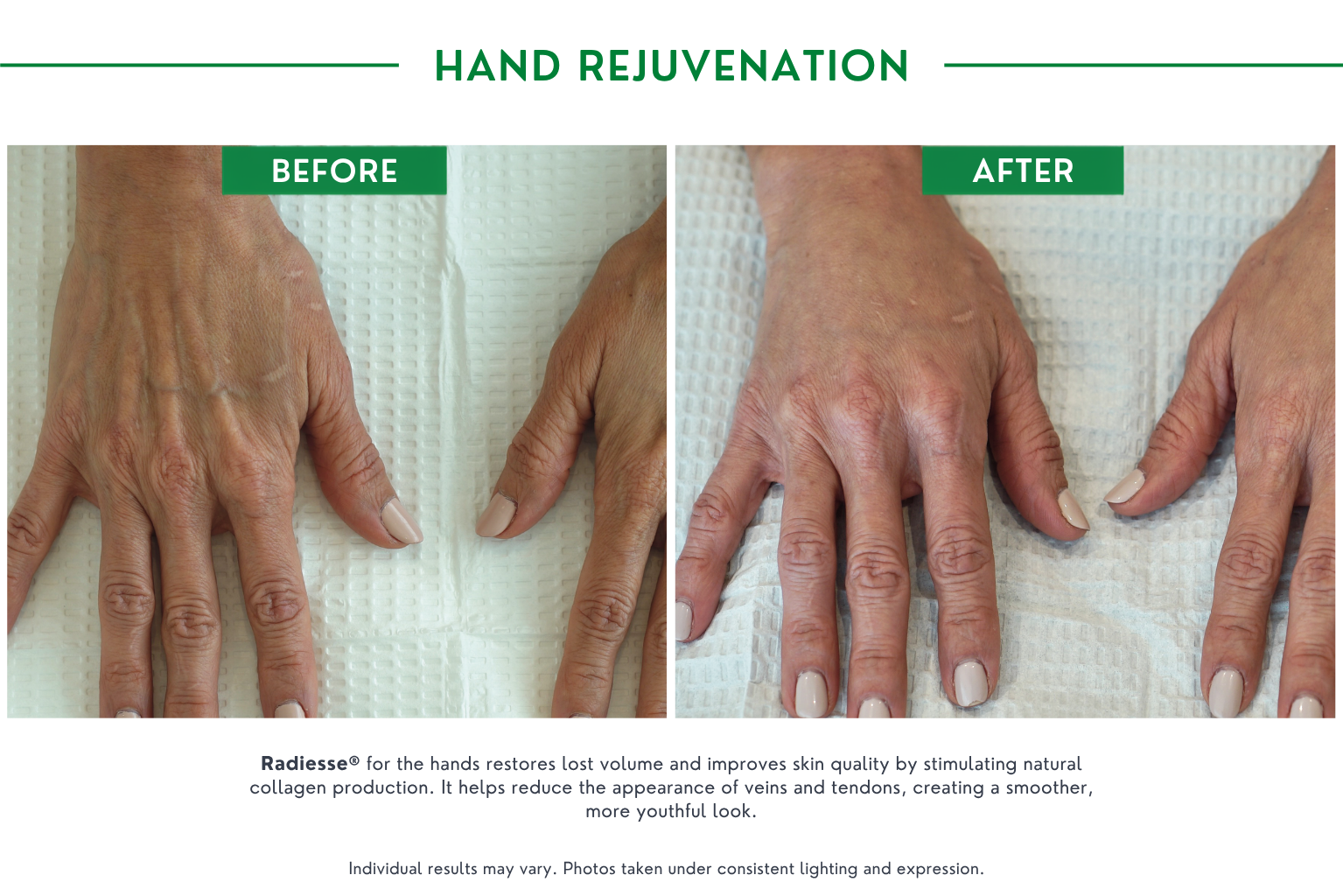 Hand rejuvenation B_A (2)