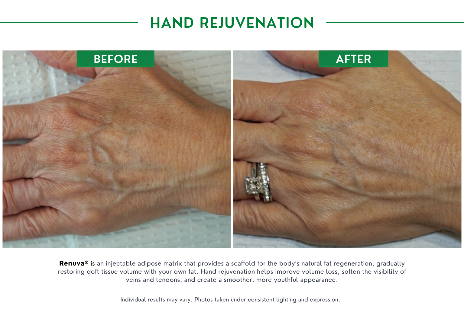 Hand rejuvenation B_A (3)