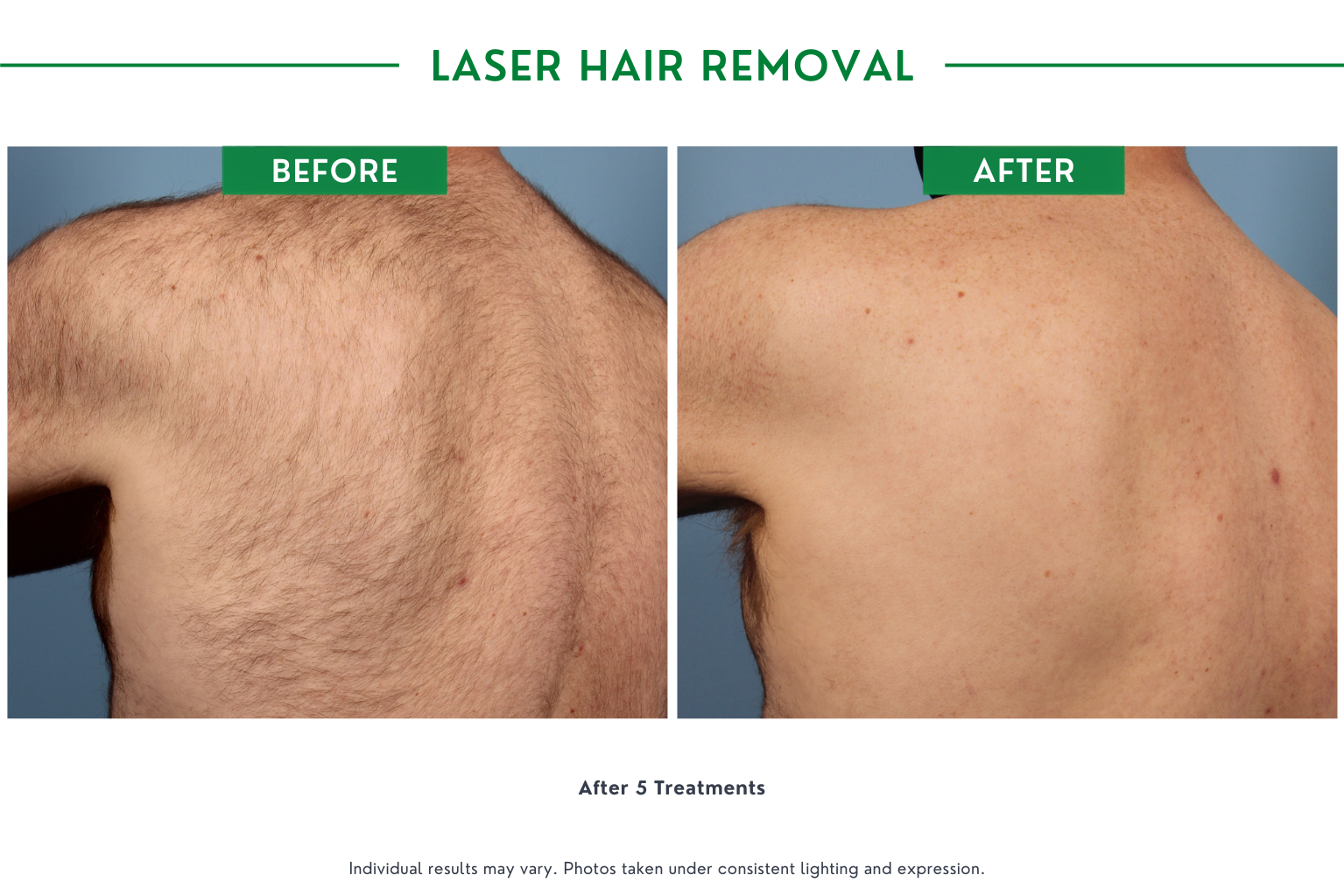 Laser Hair B_A (1)