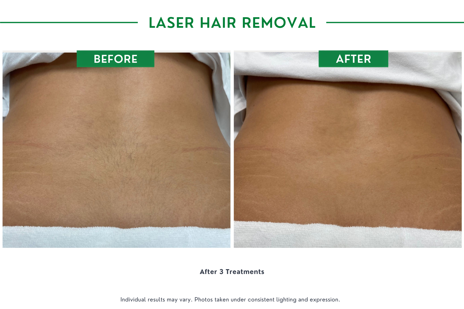 Laser Hair B_A (2)