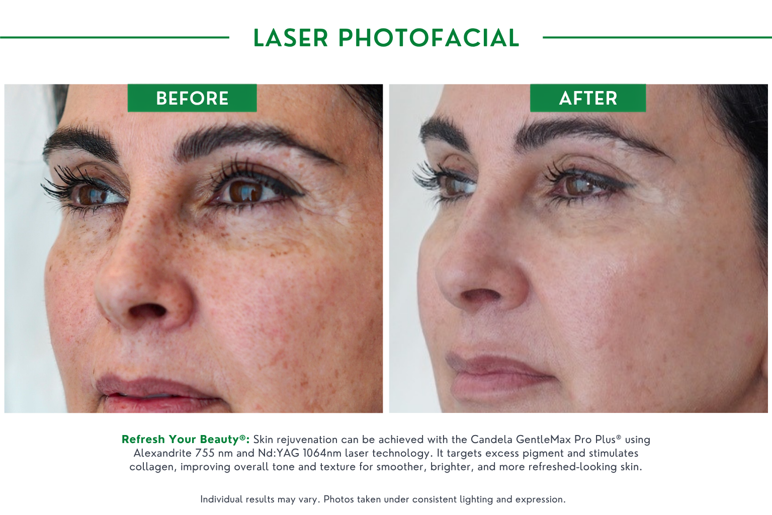 Laser Photofacial B_A (1)