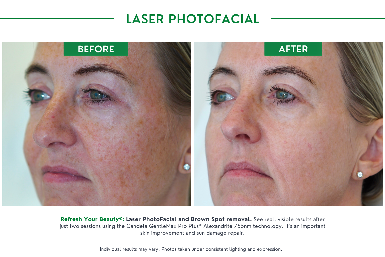 Laser Photofacial B_A (2)