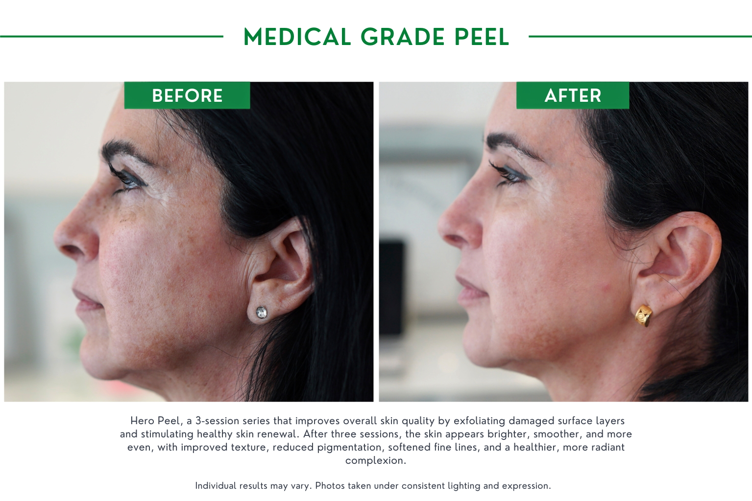 Medical peels B_A (1)