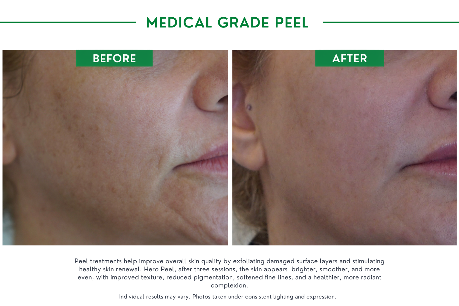 Medical peels B_A (2)