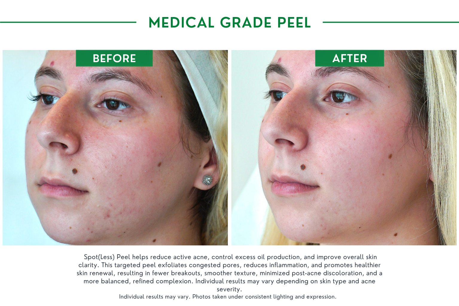 Medical peels B_A (3)