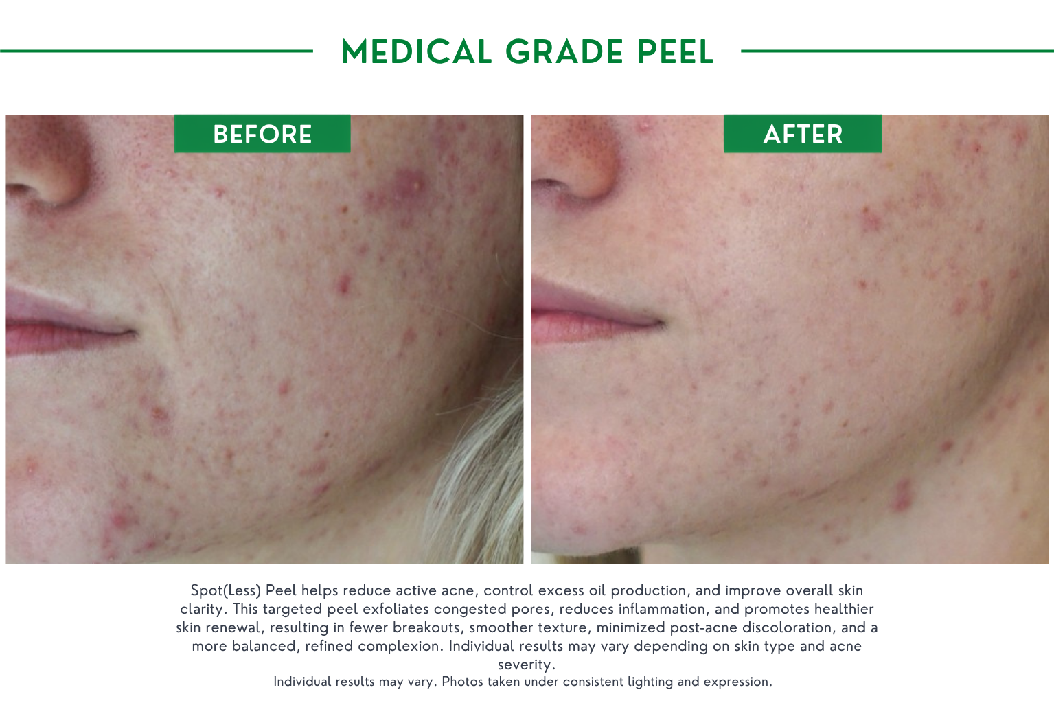 Medical peels B_A (4)