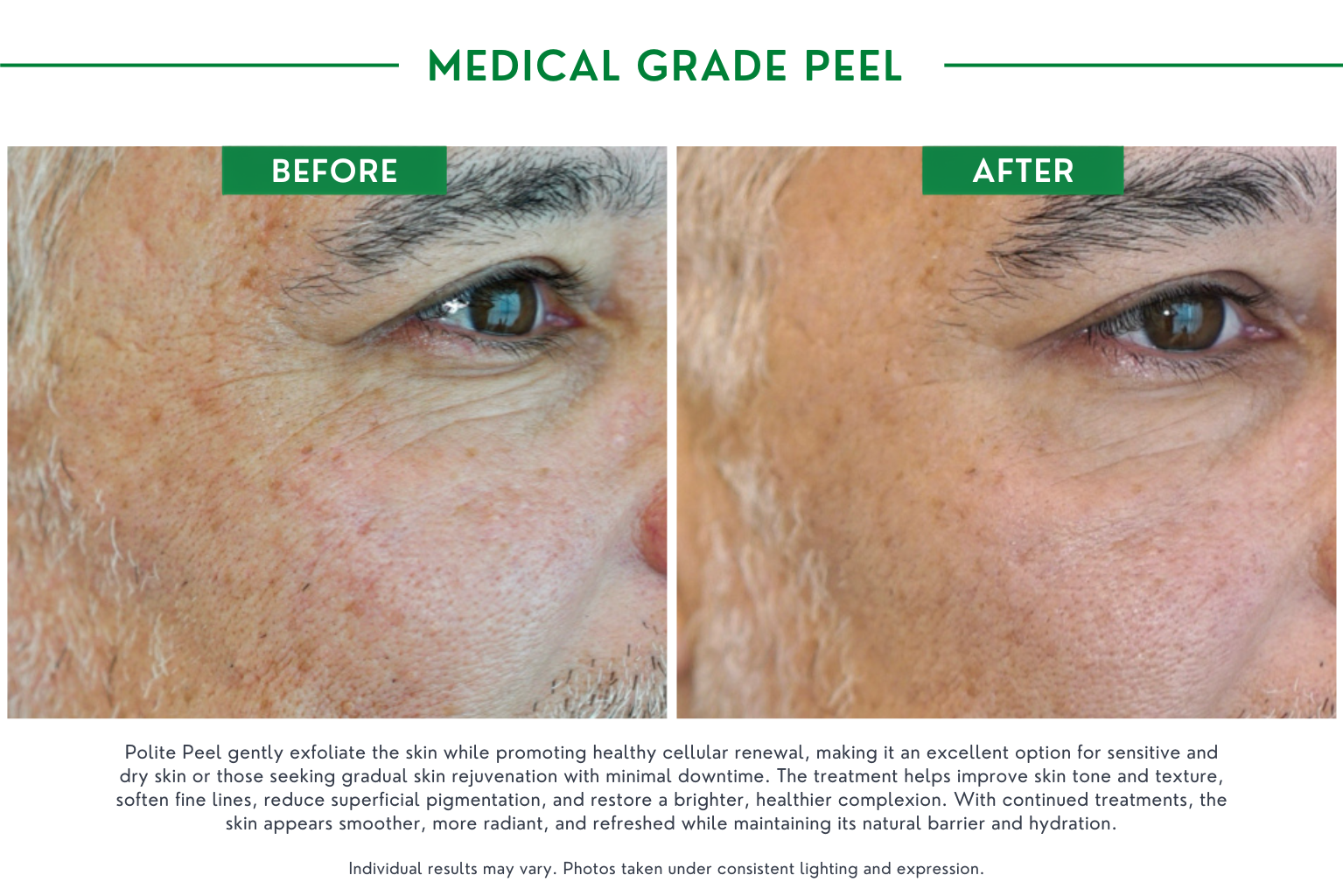 Medical peels B_A (5)