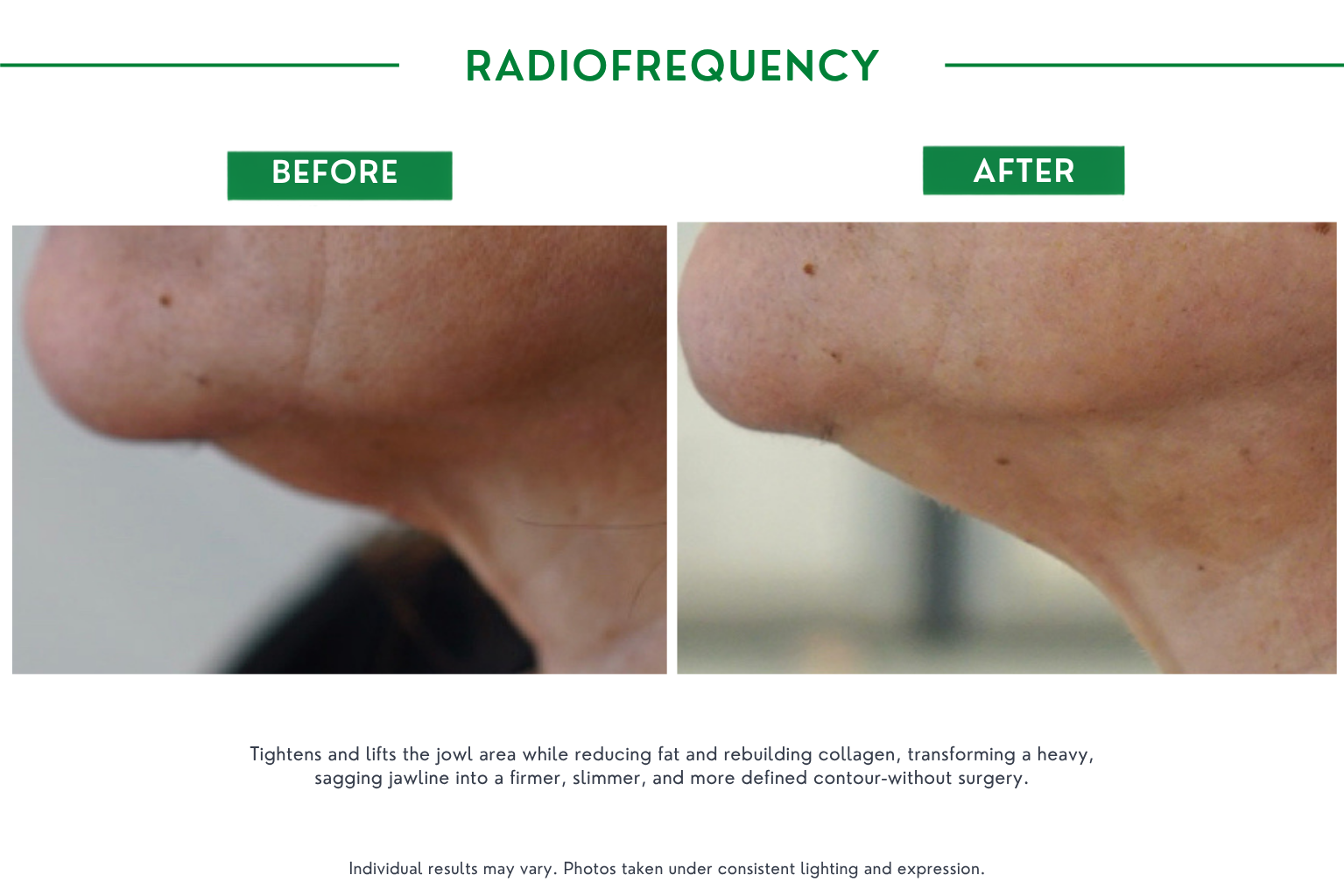 Radiofrequency B_A (1)