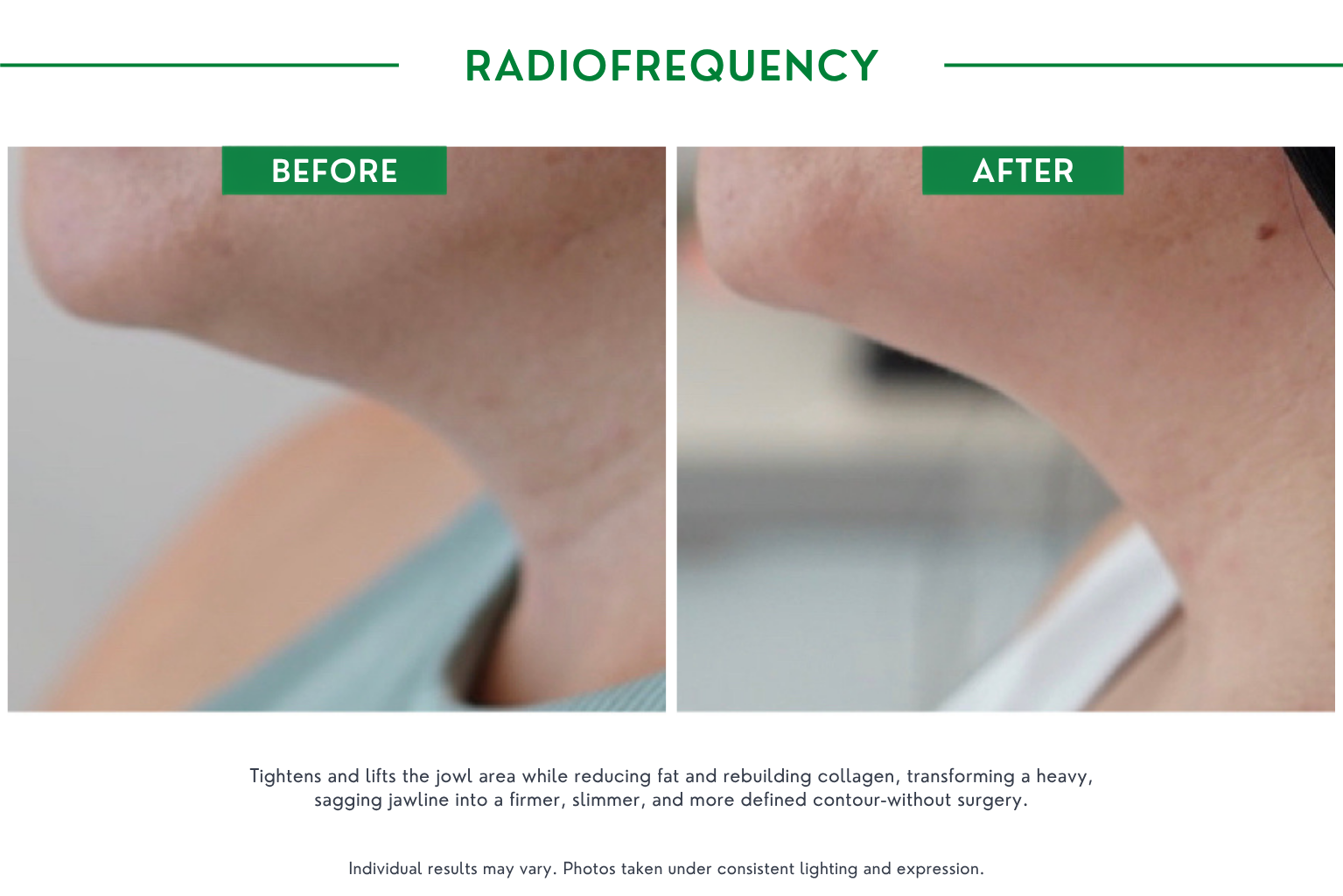 Radiofrequency B_A (2)