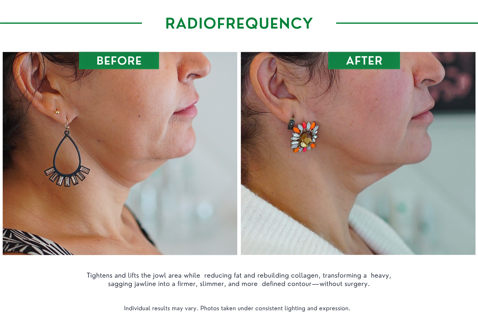 Radiofrequency B_A (3)