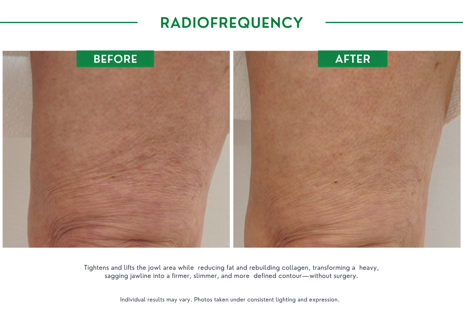 Radiofrequency B_A (4)
