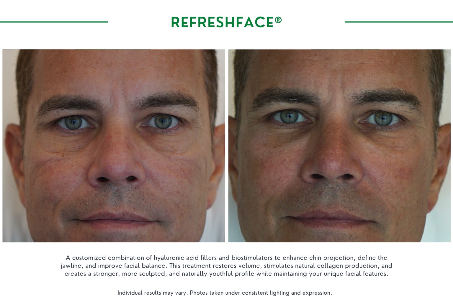 Refresh face B_A (1)