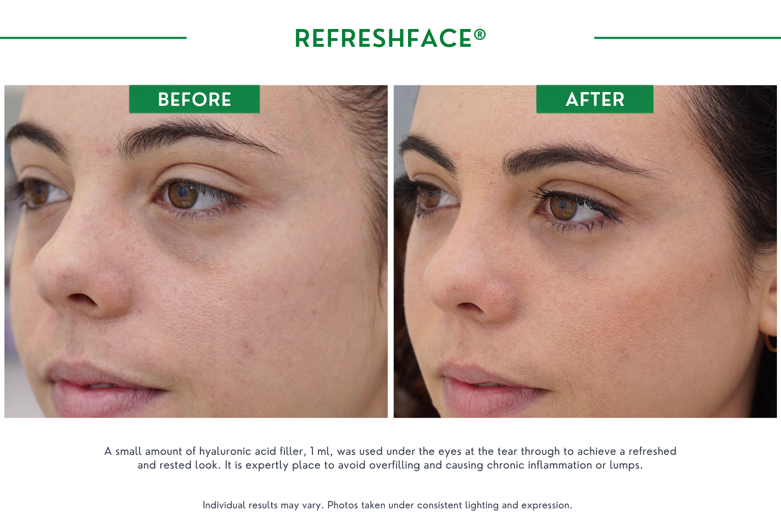 Refresh face B_A (10)