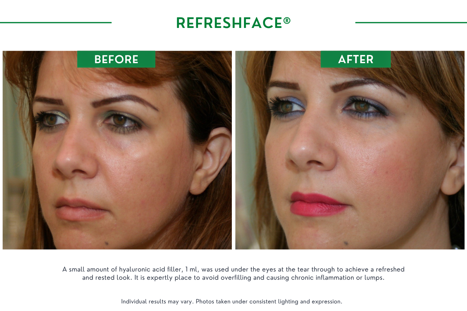Refresh face B_A (11)