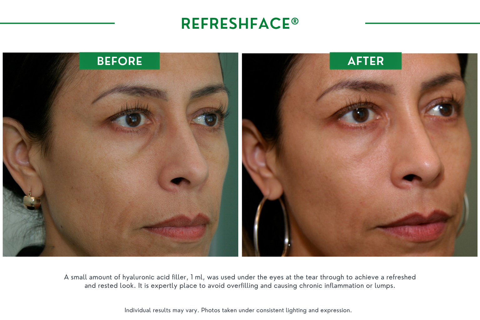 Refresh face B_A (12)