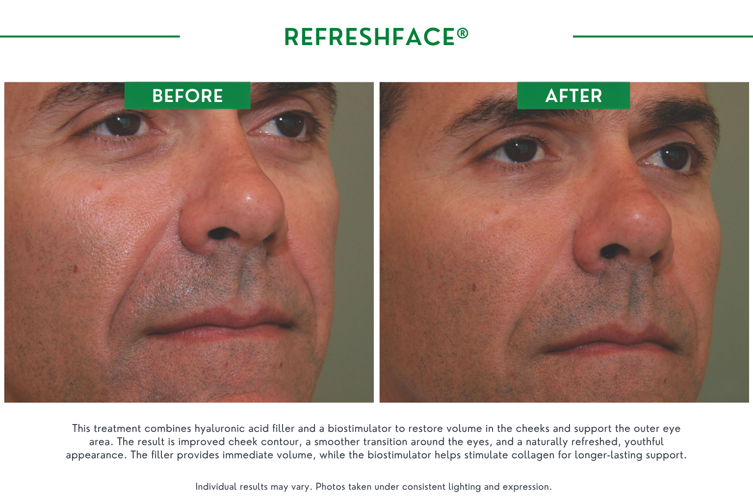 Refresh face B_A (13)