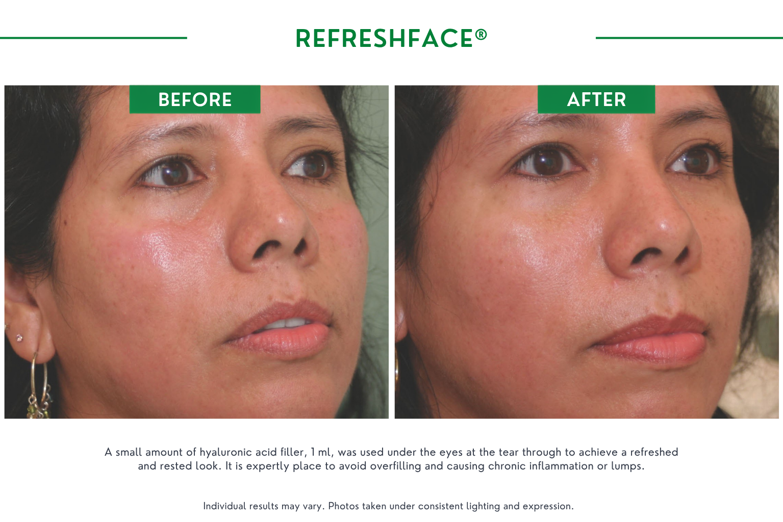 Refresh face B_A (14)