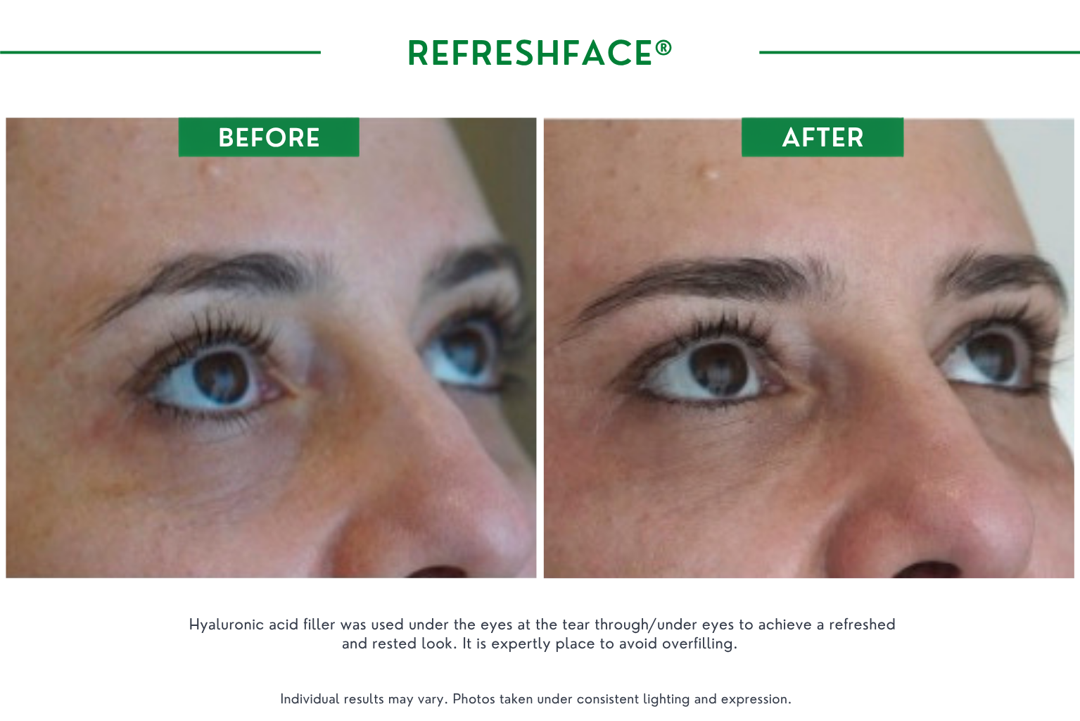Refresh face B_A (2)