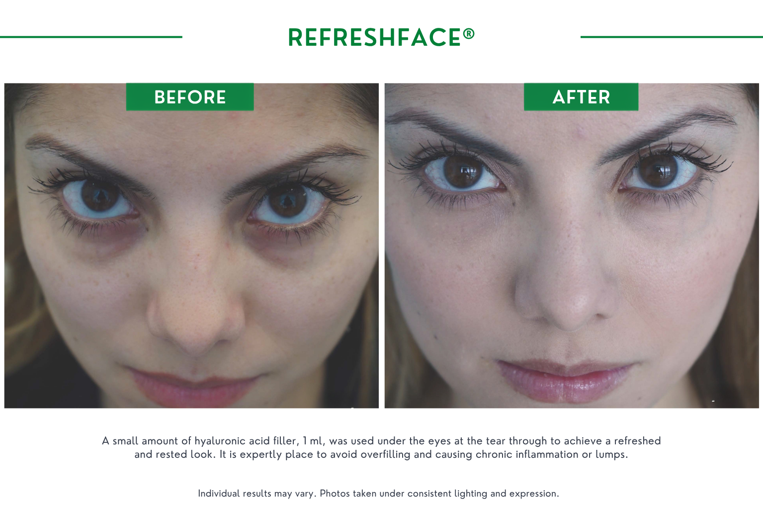 Refresh face B_A (3)