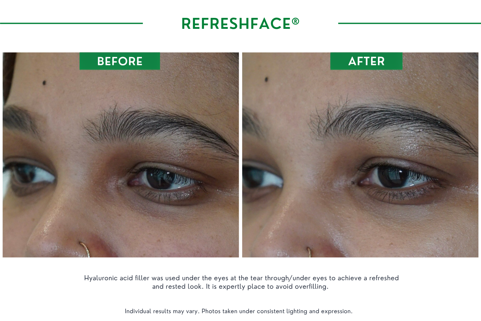 Refresh face B_A (4)