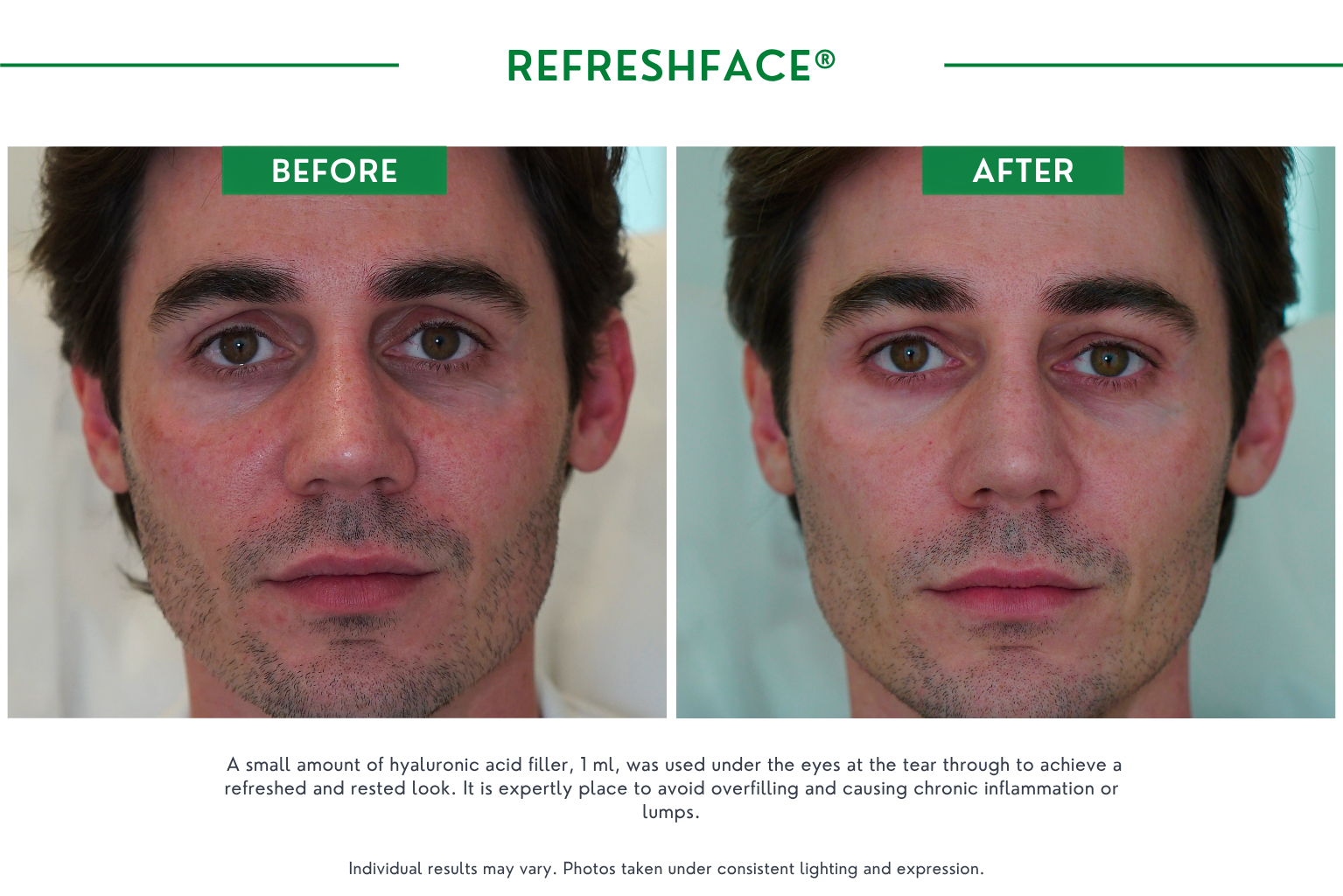 Refresh face B_A (5)