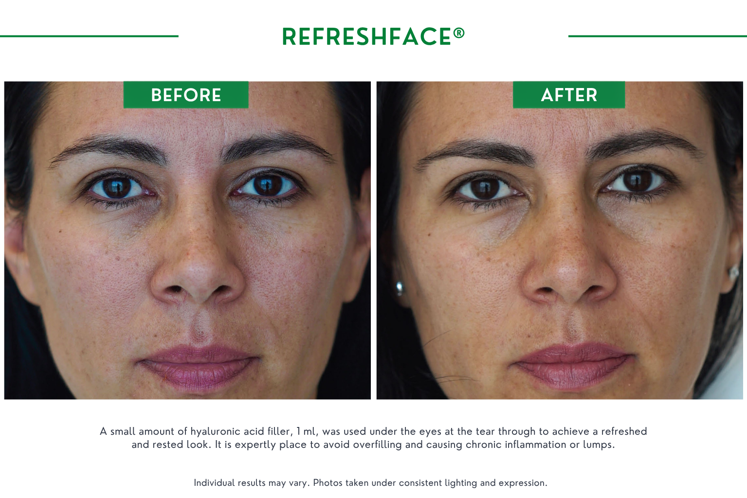 Refresh face B_A (6)