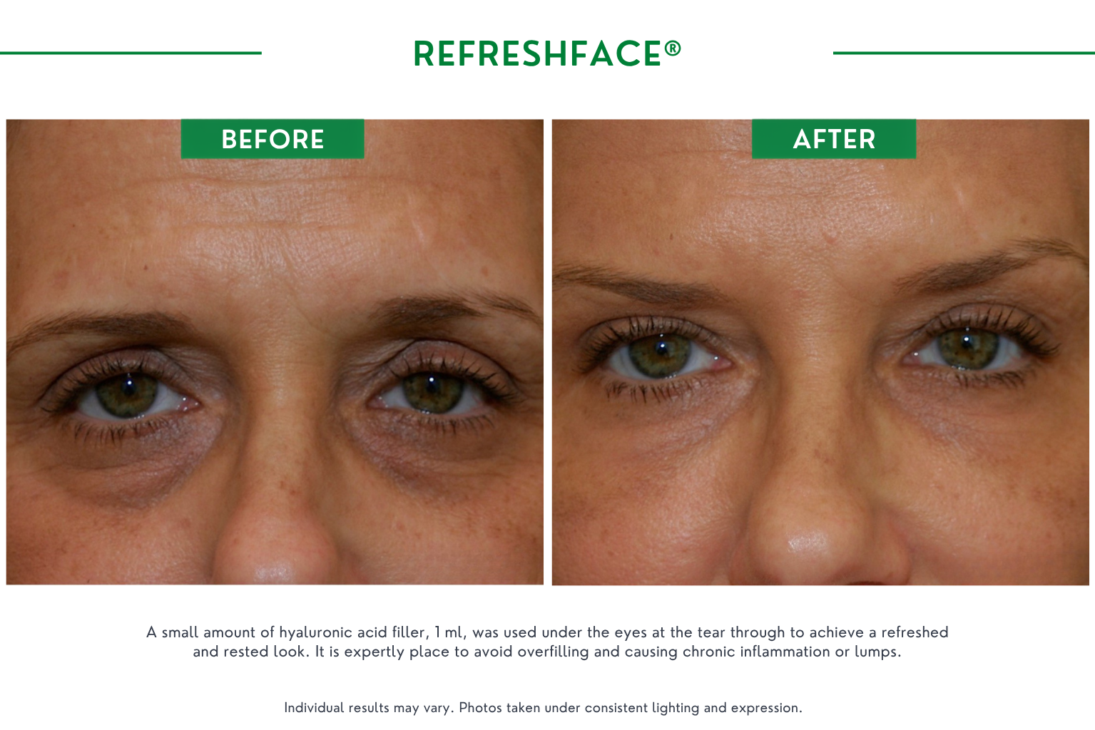 Refresh face B_A (7)