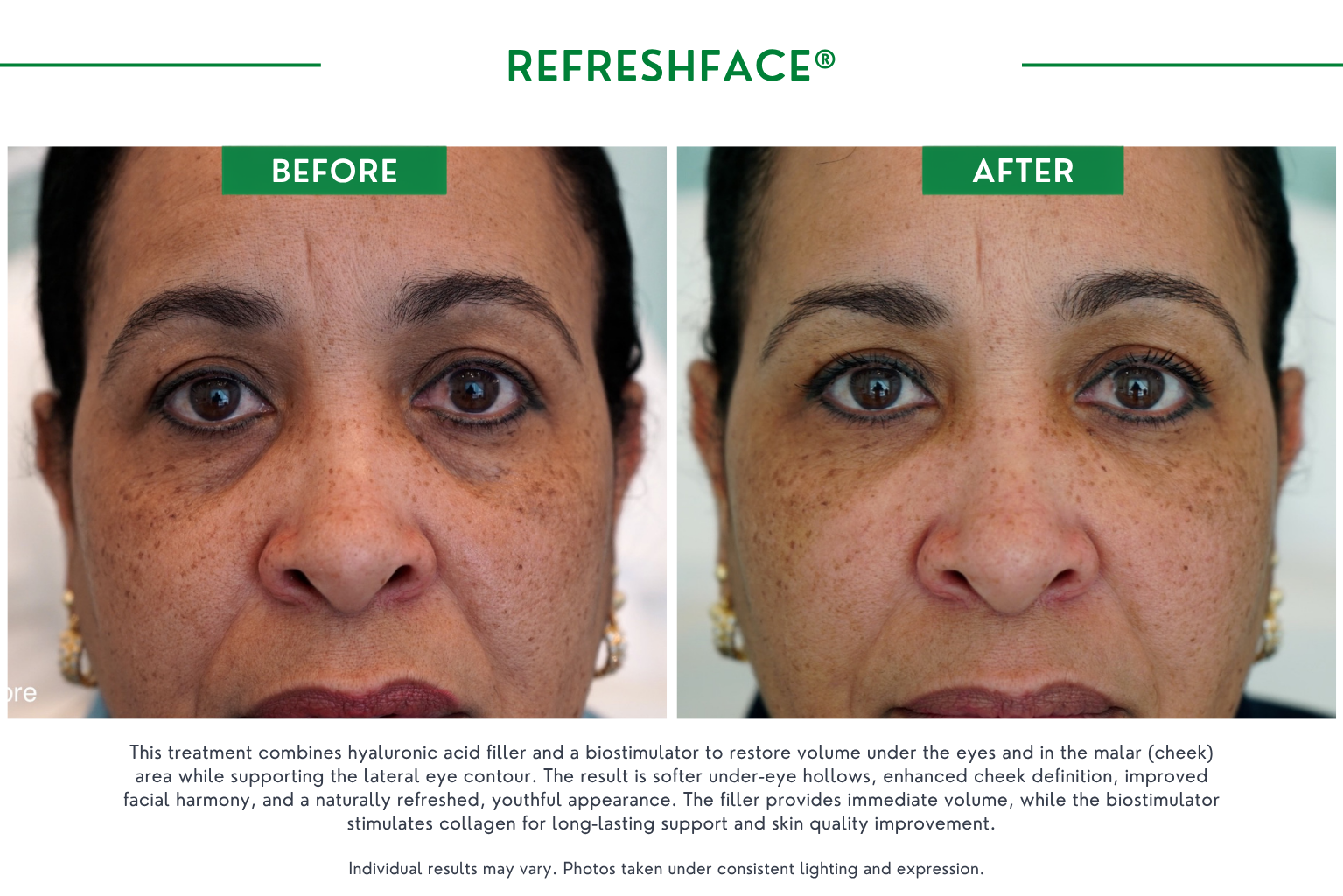 Refresh face B_A (8)
