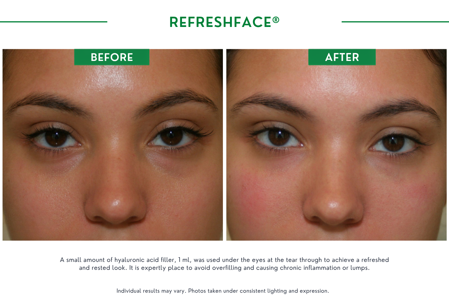 Refresh face B_A (9)