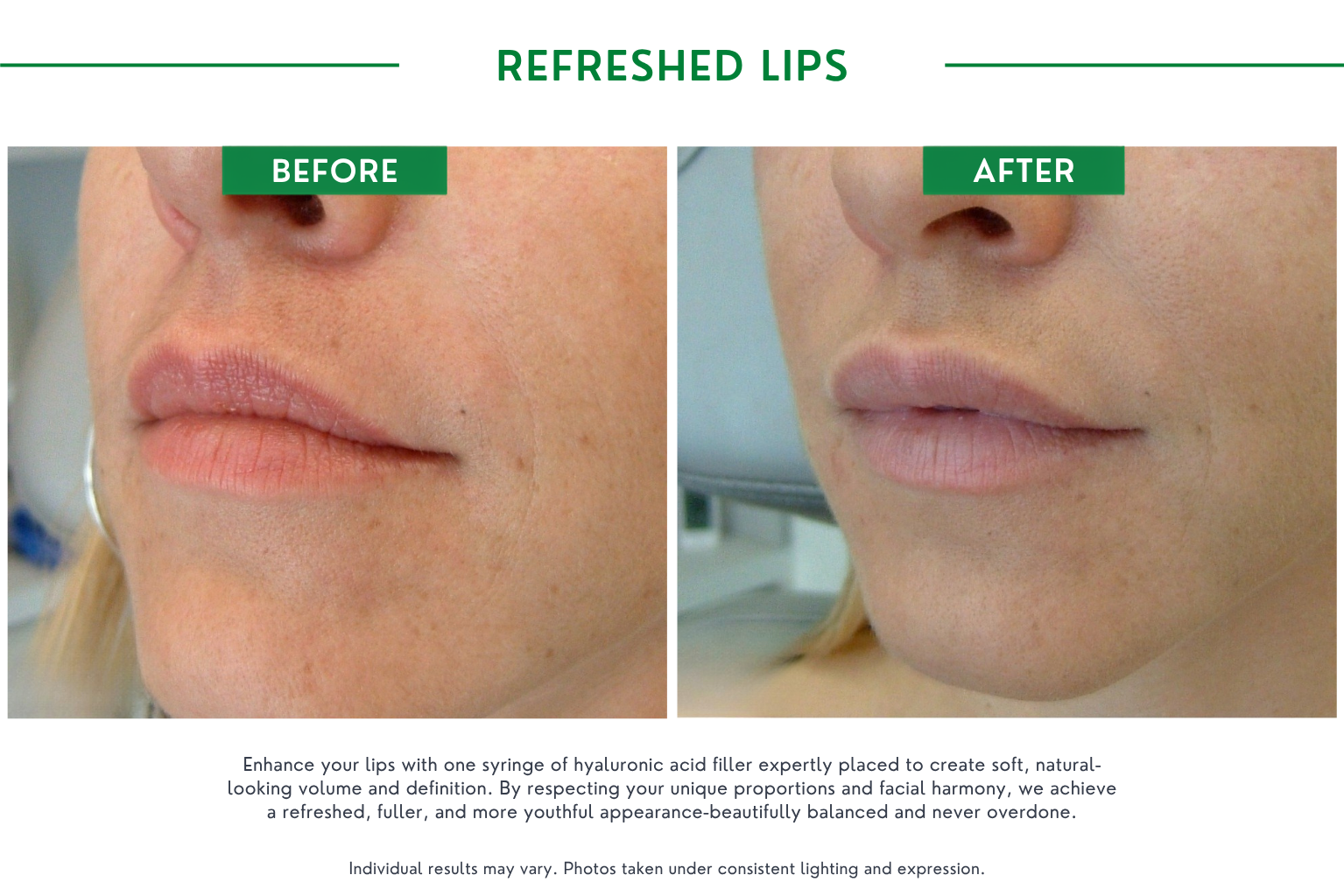 Refresh lips B_A (1)