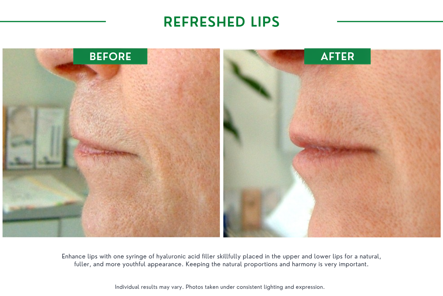 Refresh lips B_A (11)