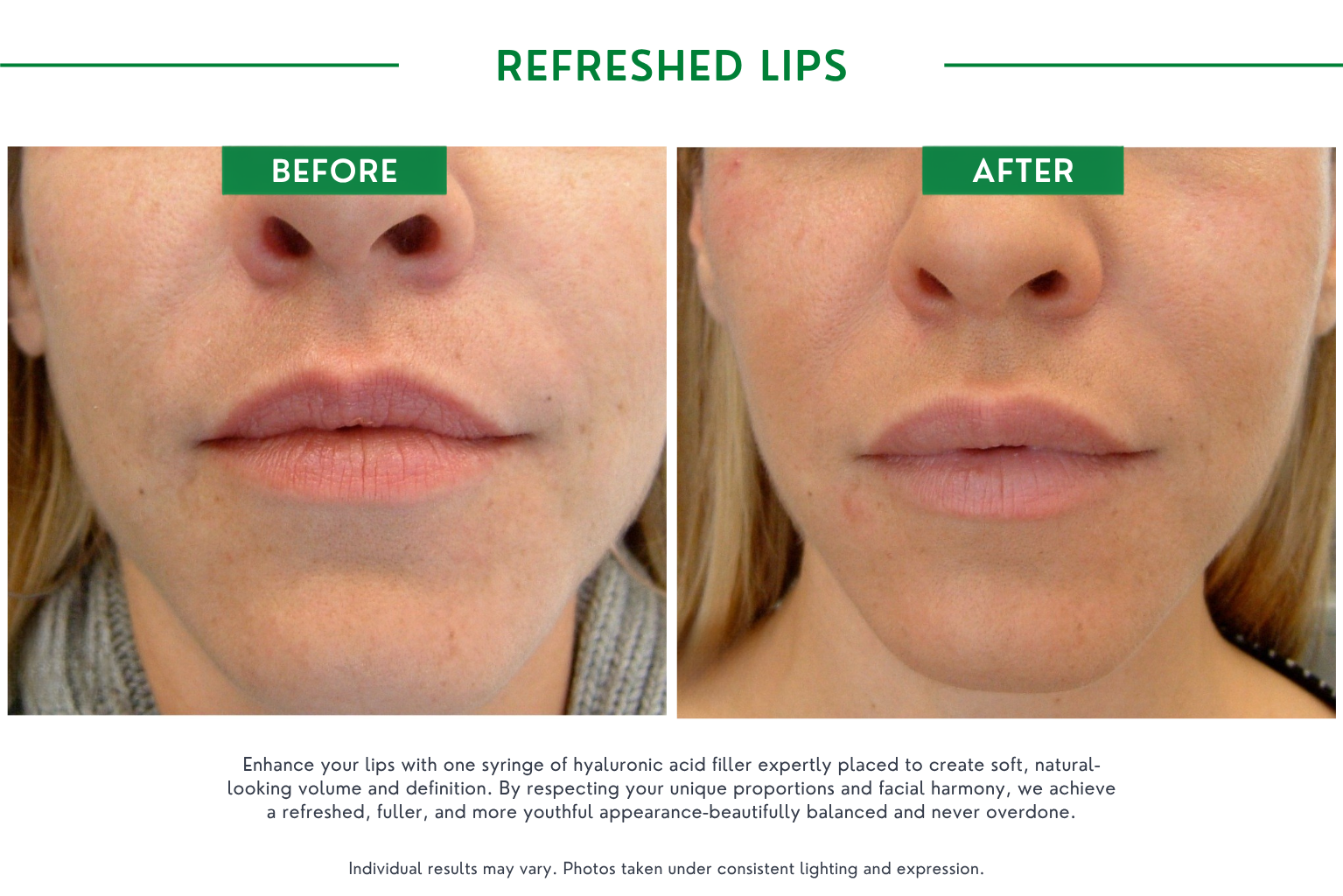 Refresh lips B_A (12)