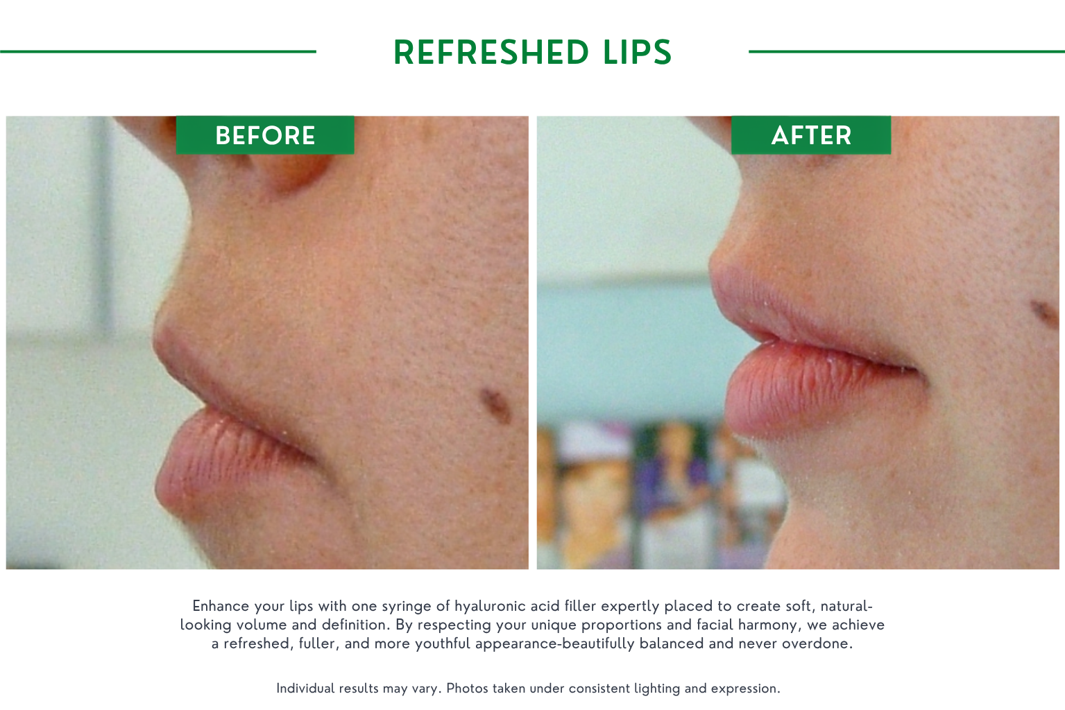Refresh lips B_A (14)