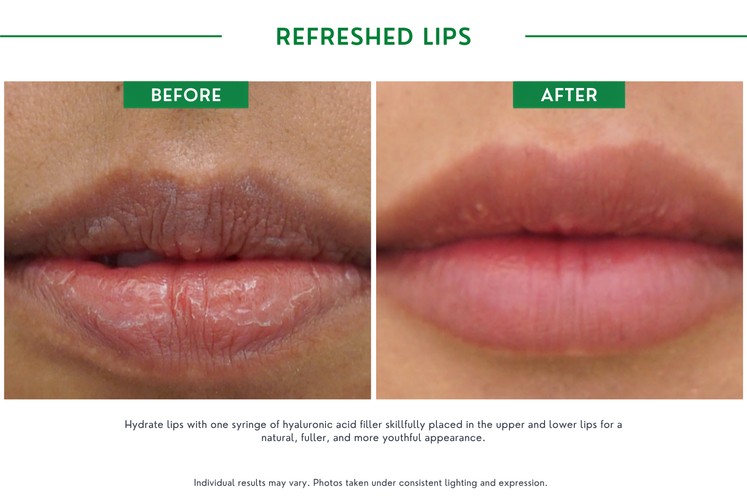 Refresh lips B_A (18)