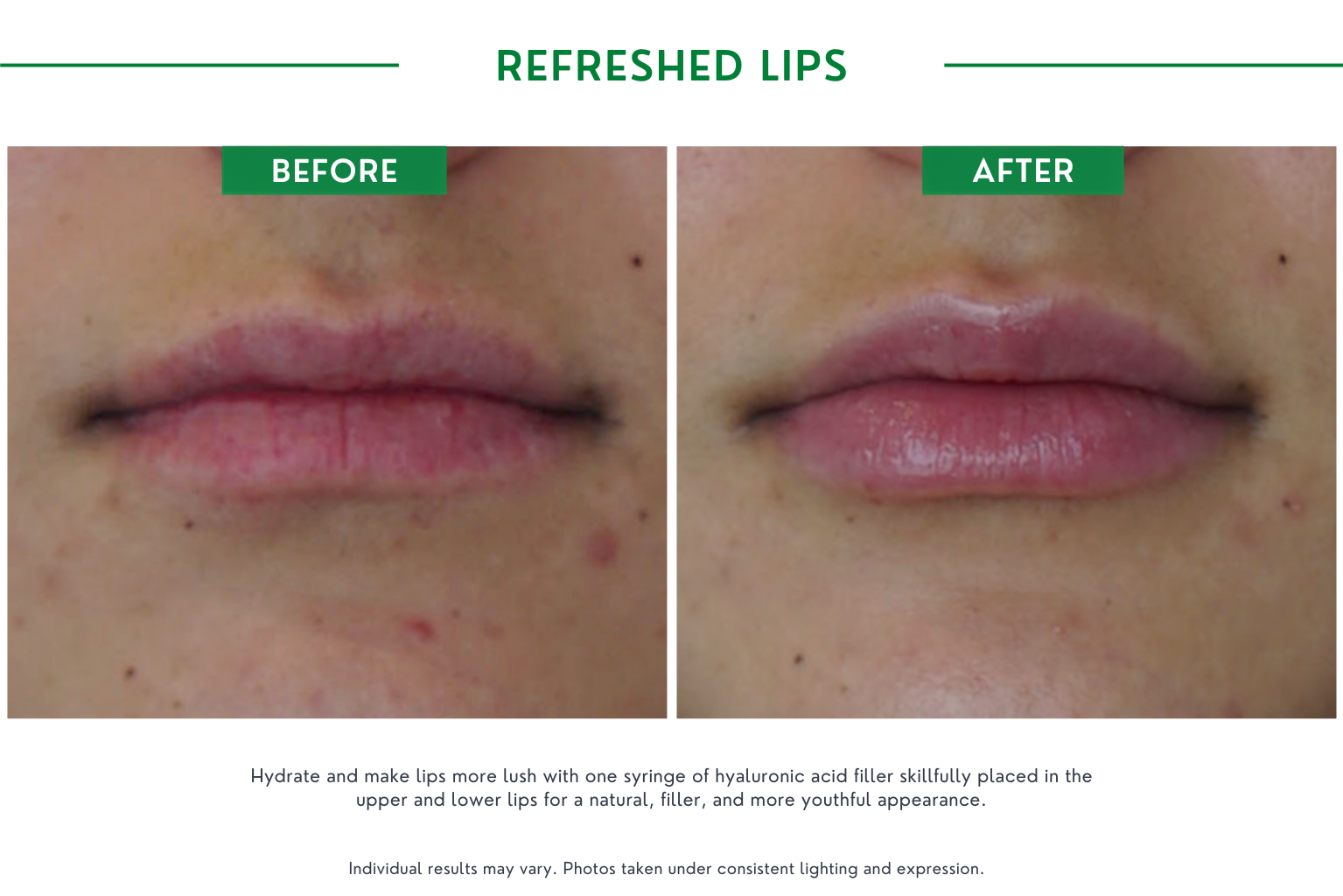Refresh lips B_A (19)