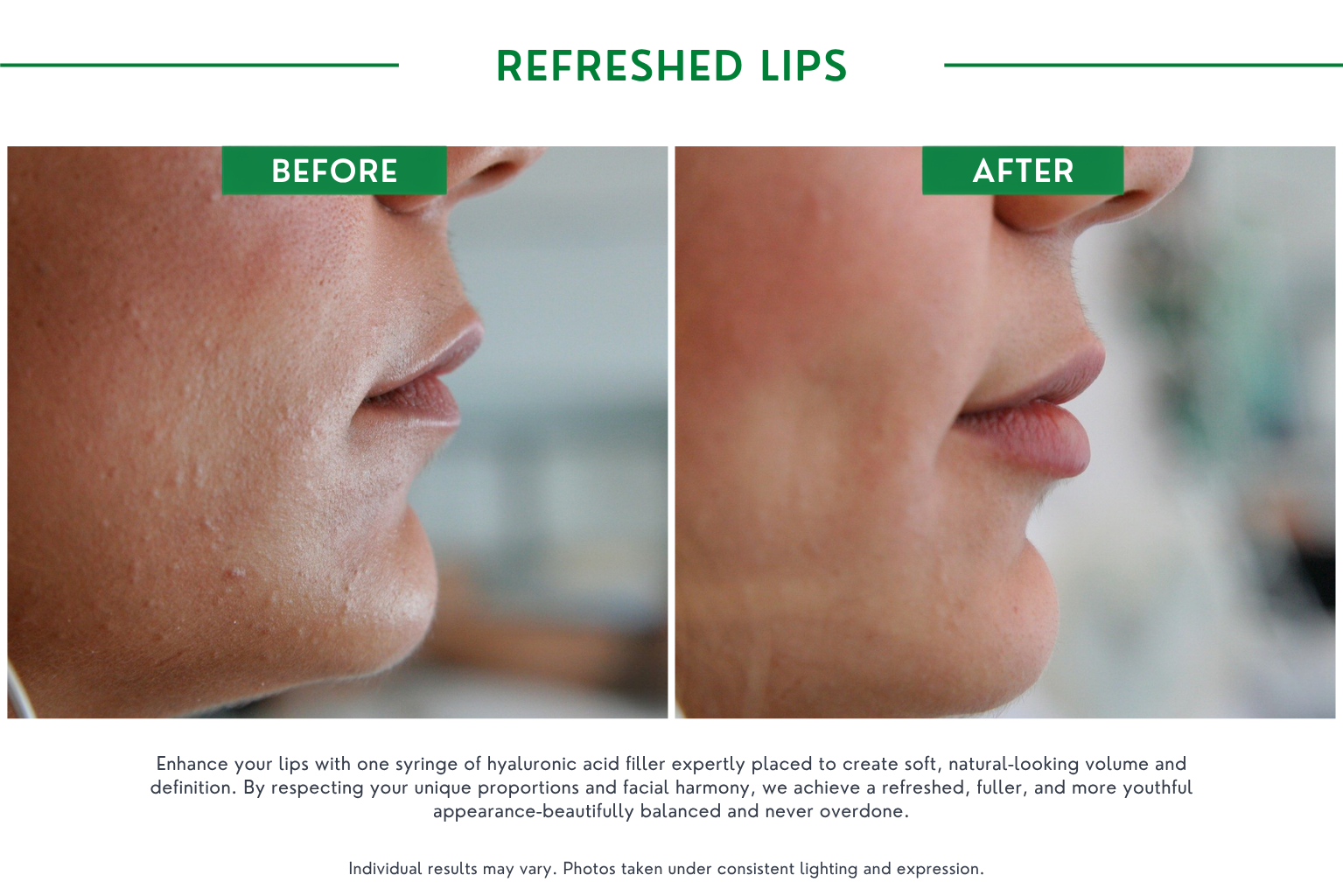 Refresh lips B_A (2)