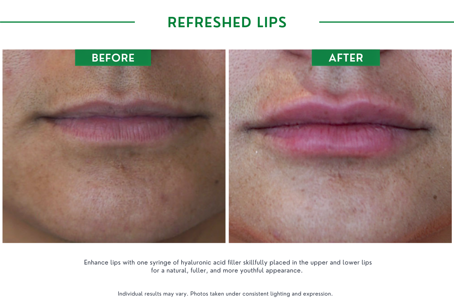 Refresh lips B_A (20)