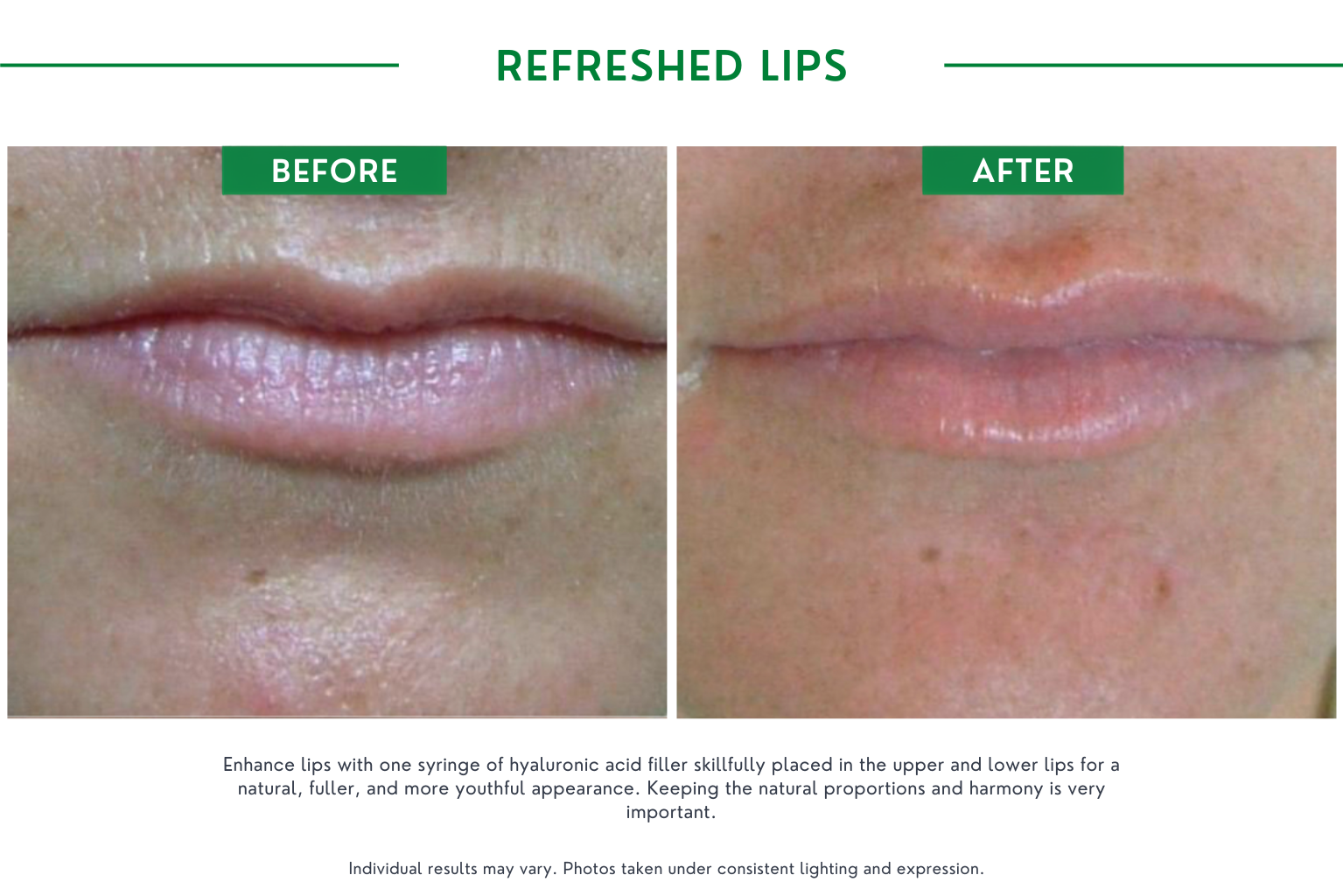 Refresh lips B_A (21)