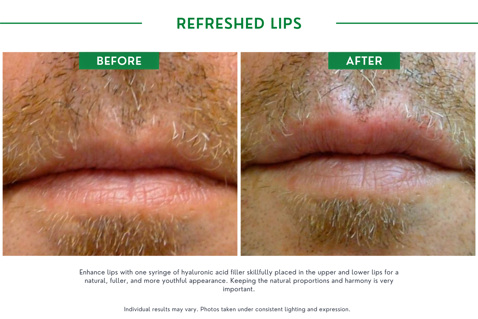 Refresh lips B_A (22)