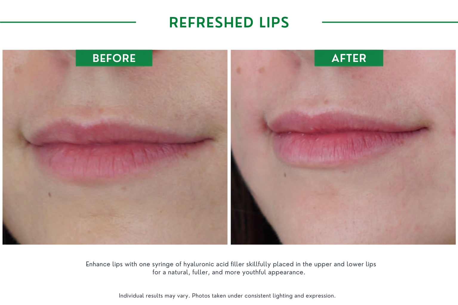 Refresh lips B_A (23)