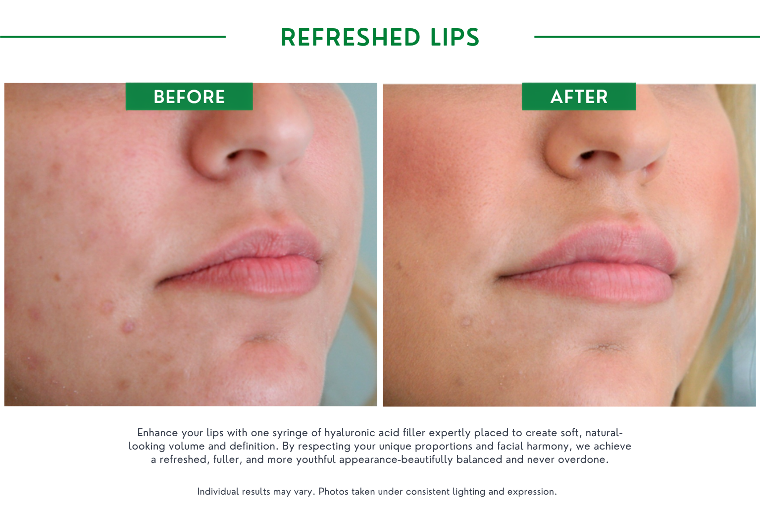 Refresh lips B_A (3)
