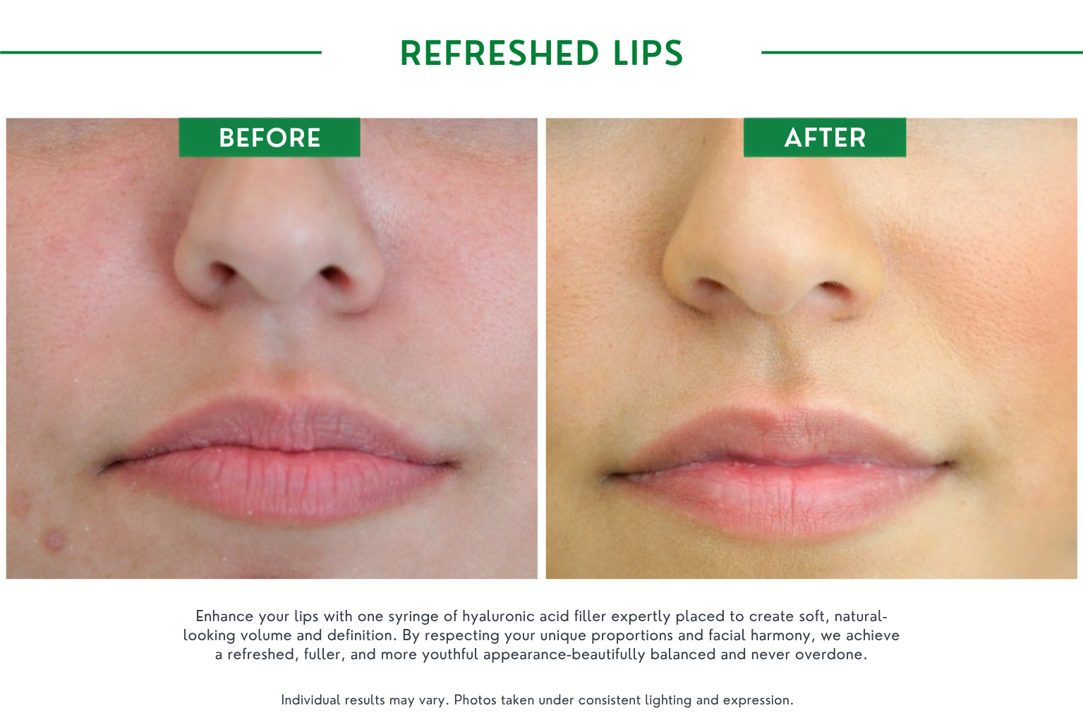 Refresh lips B_A (4)