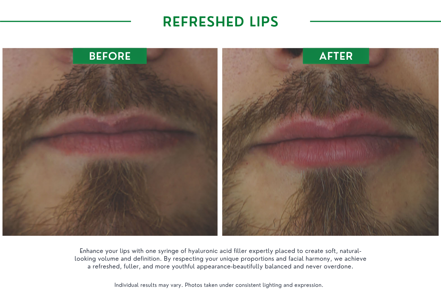 Refresh lips B_A (6)