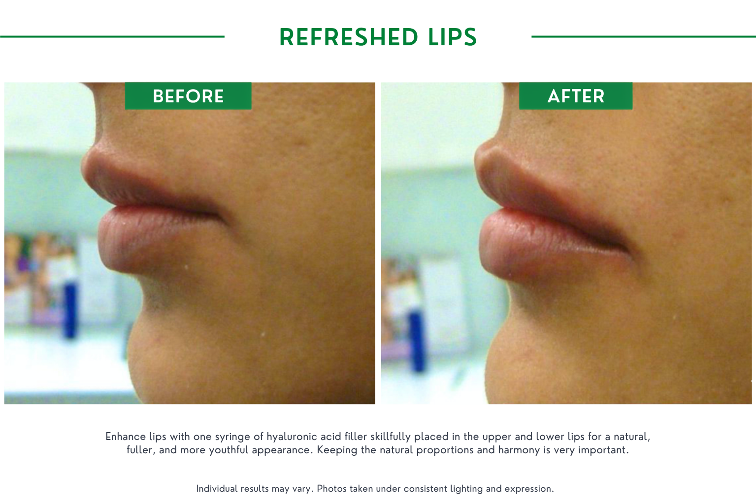 Refresh lips B_A (7)