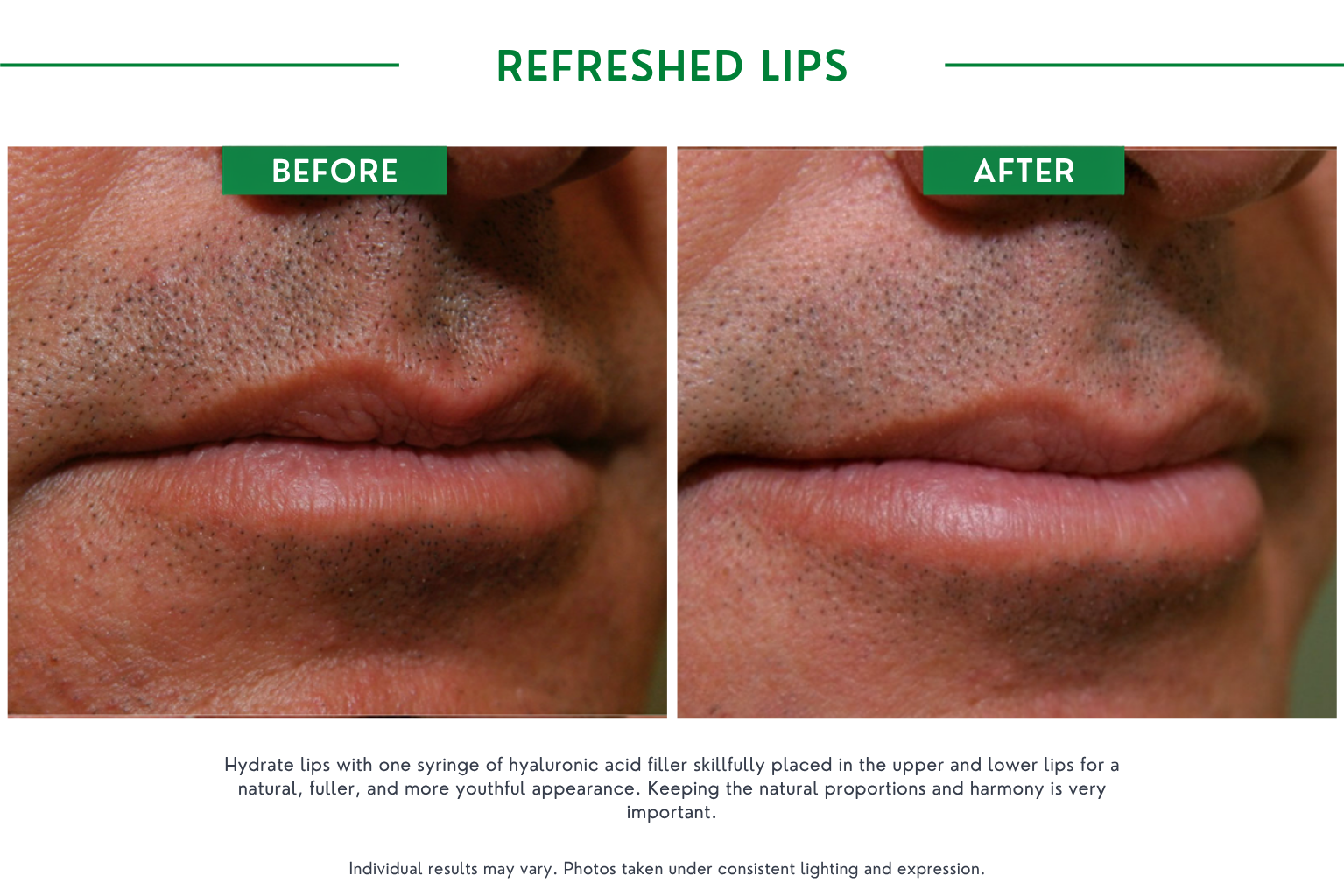 Refresh lips B_A (8)